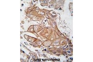 Formalin-fixed and paraffin-embedded human lung carcinoma tissue reacted with Phospho-RGS19-p. (RGS19 Antikörper  (AA 131-156))