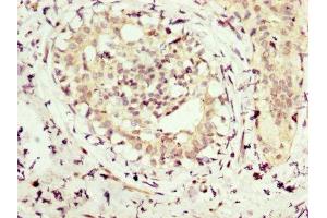 IHC image of ABIN7154254 diluted at 1:300 and staining in paraffin-embedded human breast cancer performed on a Leica BondTM system. (NMT1 Antikörper  (AA 1-158))