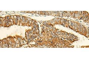 Immunohistochemistry of paraffin-embedded Human colorectal cancer tissue using IFT27 Polyclonal Antibody at dilution of 1:50(x200) (RABL4 Antikörper)