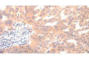 Immunohistochemistry of paraffin-embedded Human ovarian cancer using BGLAP Polyclonal Antibody at dilution of 1:40 (Osteocalcin Antikörper)