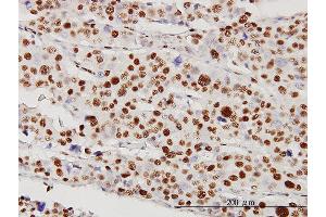 Immunoperoxidase of monoclonal antibody to STK38 on formalin-fixed paraffin-embedded human malignant lymphoma, diffuse large B tissue [antibody concentration 5 ug/ml] (STK38 Antikörper  (AA 1-465))