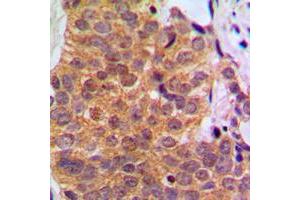 Immunohistochemical analysis of RAR beta staining in human breast cancer formalin fixed paraffin embedded tissue section. (Retinoic Acid Receptor beta Antikörper  (C-Term))