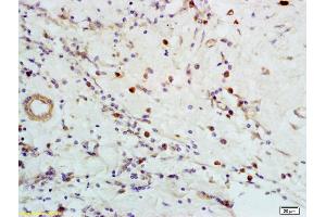 Formalin-fixed and paraffin embedded human breast carcinoma labeled with Anti-CXCR5 Polyclonal Antibody, Unconjugated (ABIN701380) at 1:200 followed by conjugation to the secondary antibody and DAB staining (CXCR5 Antikörper  (AA 281-372))