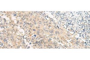 Immunohistochemistry of paraffin-embedded Human cervical cancer tissue using GPR22 Polyclonal Antibody at dilution of 1:50(x200) (GPR22 Antikörper)