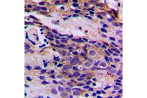 Immunohistochemical analysis of CDK5 (pY15) staining in human breast cancer formalin fixed paraffin embedded tissue section. (CDK5 Antikörper  (N-Term, pTyr15))
