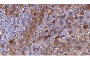 ABIN6276857 at 1/100 staining Human liver cancer tissue by IHC-P. (CD3 epsilon Antikörper  (C-Term))