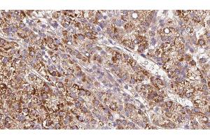 ABIN6279610 at 1/100 staining Human liver cancer tissue by IHC-P. (CHRNB4 Antikörper  (Internal Region))