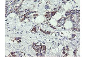 Immunohistochemical staining of paraffin-embedded Adenocarcinoma of Human breast tissue using anti-TDO2 mouse monoclonal antibody. (TDO2 Antikörper)