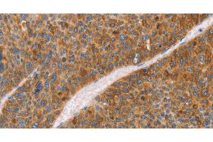 Immunohistochemistry of paraffin-embedded Human liver cancer using FGL1 Polyclonal Antibody at dilution of 1:50 (FGL1 Antikörper)