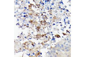 Immunohistochemistry of paraffin-embedded human lung cancer using CD68 Rabbit pAb (ABIN6132070, ABIN6138218, ABIN6138221 and ABIN6217224) at dilution of 1:50 (40x lens). (CD68 Antikörper  (AA 22-319))