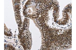 The image on the left is immunohistochemistry of paraffin-embedded Human colon cancer tissue using ABIN7128978(CMTM2 Antibody) at dilution 1/60, on the right is treated with fusion protein.