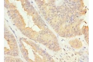 Immunohistochemistry of paraffin-embedded human endometrial cancer using ABIN7167233 at dilution of 1:100 (RAB17 Antikörper  (AA 1-212))