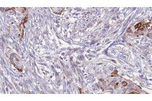 ABIN6277621 at 1/100 staining Human urothelial cancer tissue by IHC-P. (SLC3A1 Antikörper  (C-Term))