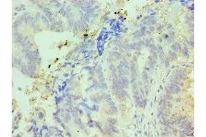 Immunohistochemistry of paraffin-embedded human colon cancer using ABIN7156999 at dilution of 1:100 (IFT57 Antikörper  (AA 170-429))
