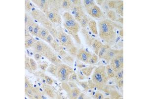Immunohistochemistry of paraffin-embedded human liver cancer using BLVRB antibody (ABIN5975104) at dilution of 1/100 (40x lens). (BLVRB Antikörper)