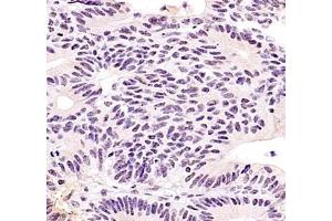 Immunohistochemistry of paraffin embedded human colon cancer using ZKSCAN4 (ABIN7076265) at dilution of 1:400 (400x lens) (ZKSCAN4 Antikörper)