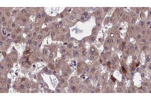 ABIN6277501 at 1/100 staining Human liver cancer tissue by IHC-P.
