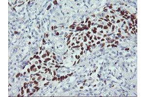 Immunohistochemical staining of paraffin-embedded Carcinoma of Human lung tissue using anti-TP53 mouse monoclonal antibody. (p53 Antikörper)