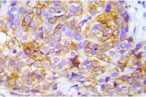 Immunohistochemistry (IHC) analyzes of p-CrkL (Try207) antibody in paraffin-embedded human lung adenocarcinoma tissue. (CrkL Antikörper  (pTyr207))