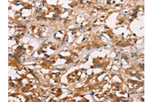 The image on the left is immunohistochemistry of paraffin-embedded Human thyroid cancer tissue using ABIN7189818(ANXA2R Antibody) at dilution 1/25, on the right is treated with synthetic peptide. (Chromosome 5 Open Reading Frame 39 (C5orf39) Antikörper)