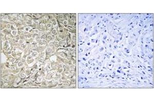 Immunohistochemistry analysis of paraffin-embedded human prostate carcinoma tissue, using RAB37 Antibody. (RAB37 Antikörper  (AA 170-219))
