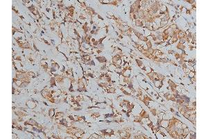 ABIN6267039 at 1/50 staining human breast cancer tissue sections by IHC-P. (Histone 3 Antikörper)