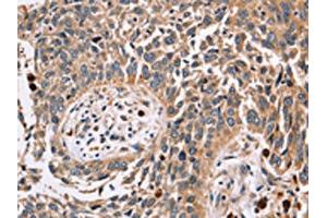 The image on the left is immunohistochemistry of paraffin-embedded Human lung cancer tissue using ABIN7129551(FUCA1 Antibody) at dilution 1/30, on the right is treated with fusion protein. (FUCA1 Antikörper)