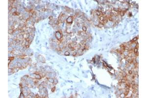 Formalin-fixed, paraffin-embedded human Prostate Carcinoma stained with STAT2 Mouse Monoclonal Antibody (STAT2/2650). (STAT2 Antikörper)