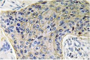 Immunohistochemistry analysis of AQP4 Antibody in Paraffin-Embedded Human lung carcinoma tissue. (Aquaporin 4 Antikörper)