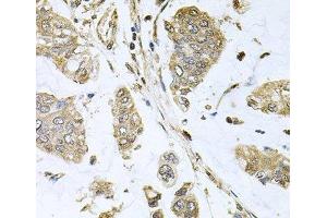 Immunohistochemistry of paraffin-embedded Human gastric cancer using SBDS Polyclonal Antibody at dilution of 1:100 (40x lens). (SBDS Antikörper)