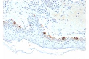 Formalin-fixed, paraffin-embedded human Skin stained with TYRP1-Monospecific Mouse Monoclonal Antibody (TYRP1/3281). (Tyrosinase-Related Protein 1 Antikörper  (AA 257-377))