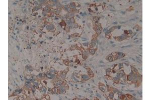 IHC-P analysis of Human Pancreatic cancer Tissue, with DAB staining. (KRT15 Antikörper  (AA 105-411))