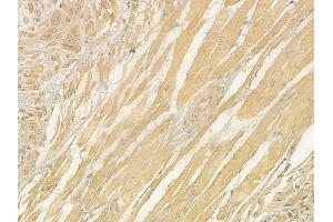 ABIN6265790 and ABIN6276352 at 1/100 staining human tongue carcinoma by IHC-P. (TUBA4A Antikörper  (N-Term))