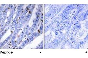 Immunohistochemical analysis of paraffin-embedded human colon carcinoma tissue using PRKAR2B polyclonal antibody . (PRKAR2B Antikörper  (Ser113))