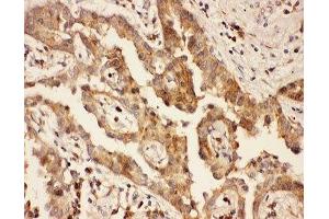 IHC-P: CXCR3 antibody testing of human lung cancer tissue