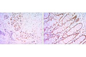 Immunohistochemical analysis of paraffin-embedded lung cancer tissues (left) and human rectum tissues (right) using KLF4 mouse mAb with DAB staining. (KLF4 Antikörper  (AA 2-470))
