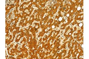ABIN7094414 and ABIN7098461 at 1/100 staining Human pancreatic cancer by IHC-P. (OGDHL Antikörper  (Internal Region))