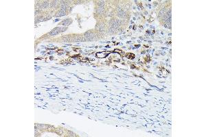 Immunohistochemistry of paraffin-embedded human colon carcinoma using von Willebrand factor (VWF) Rabbit pAb (ABIN3015449, ABIN3015450, ABIN5663874 and ABIN6217310) at dilution of 1:50 (40x lens). (VWF Antikörper  (AA 50-150))