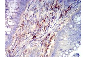 Immunohistochemical analysis of paraffin-embedded rectum cancer tissues using CD61 mouse mAb with DAB staining. (Integrin beta 3 Antikörper  (AA 27-179))