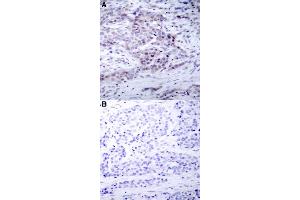 Immunohistochemical staining of human breast cancer tissue with NFKB2 (phospho S870) polyclonal antibody  without blocking peptide (A) or preincubated with blocking peptide (B) under 1:50-1:100 dilution.