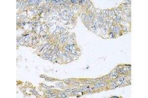 Immunohistochemistry of paraffin-embedded Human colon carcinoma using HDAC3 Polyclonal Antibody at dilution of 1:100 (40x lens). (HDAC3 Antikörper)