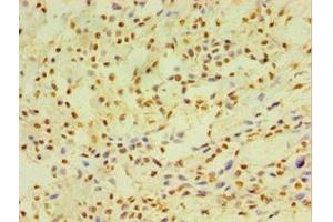 Immunohistochemistry of paraffin-embedded human breast cancer using ABIN7149254 at dilution of 1:100 (CYP2J2 Antikörper  (AA 328-502))