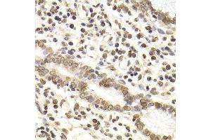 Immunohistochemistry of paraffin-embedded human gastric cancer using LMNB2 Antibody. (Lamin B2 Antikörper  (AA 341-620))