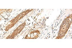 Immunohistochemistry of paraffin-embedded Human esophagus cancer tissue using DCAF10 Polyclonal Antibody at dilution of 1:130(x200)