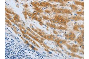 The image on the left is immunohistochemistry of paraffin-embedded Human liver cancer tissue using ABIN7190248(CHRFAM7A Antibody) at dilution 1/40, on the right is treated with synthetic peptide. (CHRNA7 Antikörper)