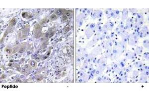 Immunohistochemistry analysis of paraffin-embedded human liver carcinoma tissue using MRPS18A polyclonal antibody . (MRPS18A Antikörper)
