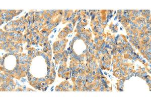 Immunohistochemistry of paraffin-embedded Human thyroid cancer tissue using RIPK4 Polyclonal Antibody at dilution 1:40 (RIPK4 Antikörper)