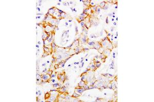 Anti-beta Catenin antibody, IHC(P) IHC(P): Human Mammary Cancer Tissue (CTNNB1 Antikörper  (C-Term))