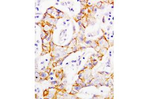 Anti-beta Catenin antibody, IHC(P) IHC(P): Human Mammary Cancer Tissue