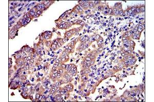 Immunohistochemical analysis of paraffin-embedded intima cancer tissues using CRK mouse mAb with DAB staining. (Crk Antikörper)